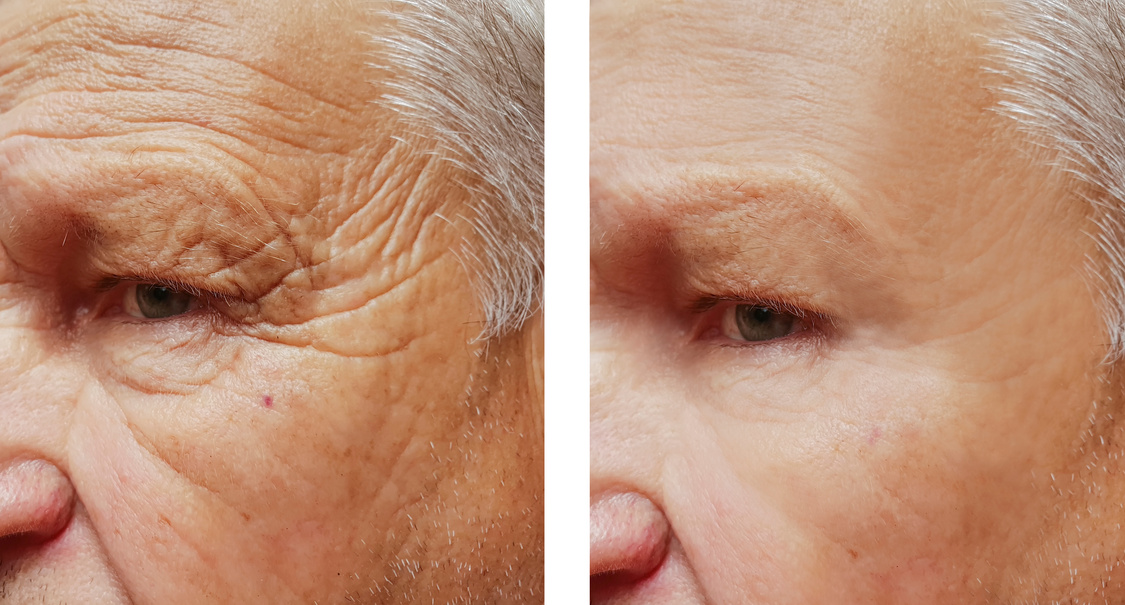 face elderly man forehead wrinkles face before and after procedures